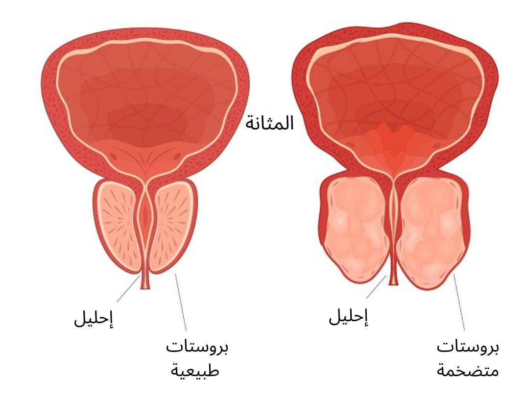 ضخامة البروستات